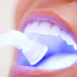 ¿Qué son los Blanqueamientos Dentales?